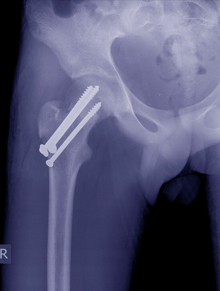 Röntgenaufnahme einer postoperativen Hüftfraktur mit Schrauben