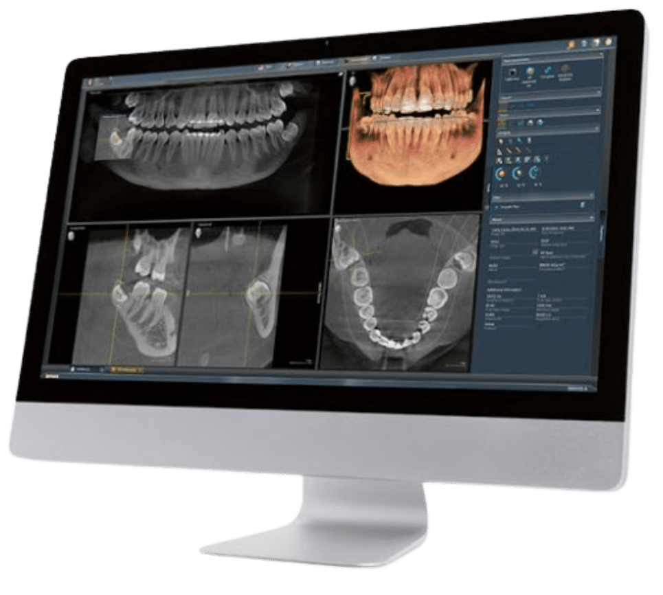 Digitale Volumentomographie DVT 3d Röntgen Bildschirm