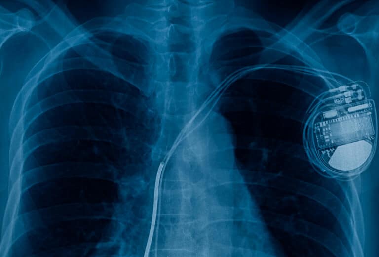 Röntgenaufnahme Herzschrittmacher