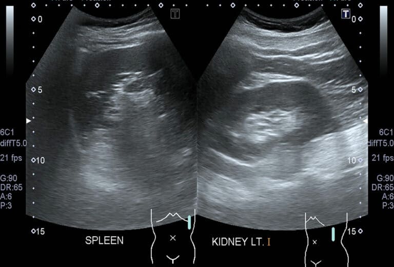 Ultraschall Aufnahme der Nieren
