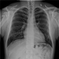 Röntgenaufnahme Herz-Lungen-Röntgen
